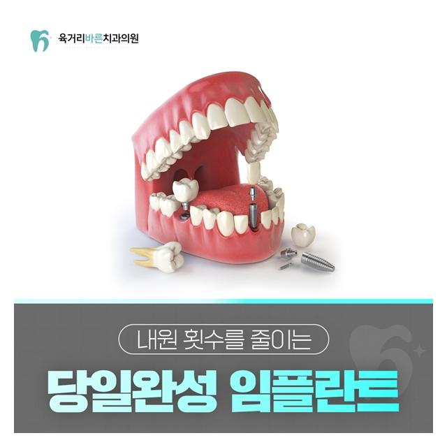 당일완성 임플란트 내원 횟수를 줄이는 치료 완료